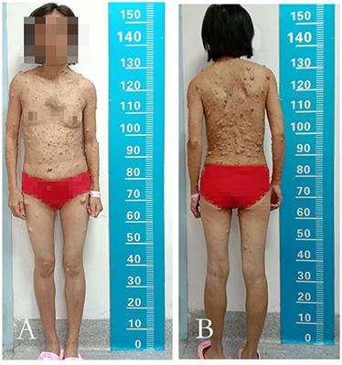 Extracranial Vertebral Artery-Internal Jugular Vein-Spinal Vein Fistula in Neurofibromatosis Type I: Case Report and Literature Review